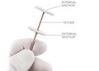 Revivent TC - Anteroseptal Anchor System Implant