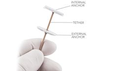 Revivent TC - Anteroseptal Anchor System Implant