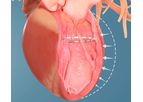 Ancora Accucinch - Ventricular Restoration System for Patients