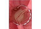 Ancora Accucinch - Ventricular Restoration System for Physicians