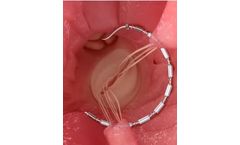 Ancora Accucinch - Ventricular Restoration System for Physicians