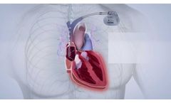 BIOTRONIK Closed Loop Stimulation Offers the Most Physiological Rate Regulation* - Video