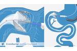 EndoBarrier - Placement, Action and Removal - Video