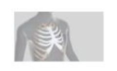 Anatomics StarPore Thoracic Reconstruction - Video