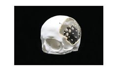 AnatomicsAcrylic - Cranial Implant