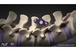 Posterior Interbody Surgical Technique Guide - Video
