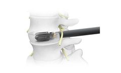 Omega - Model XP - Expandable Lumbar Interbody System