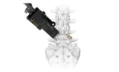Karma / Karma - Model MIS - Novel Metal-Free Cortico-Pedicular Fixation System