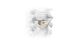 Crystal - Model Ti-Bond - Cervical Interbody System
