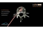 InFill Interbody Fusion Systems - Overview- Pinnacle Spine Group- Video