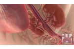 Red Vascular Branch Endograft System: Aortic Aneurysm - Video