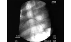 Nonmodular Branched Thoracic Endograft, Bovine - Video