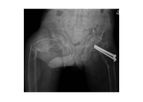 Hybrid Treatment of a Subtrochanteric Femoral Fracture