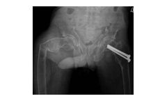 Hybrid Treatment of a Subtrochanteric Femoral Fracture