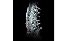 Biedermann - Model MOSS VRS - Pedicle Screw Sytems
