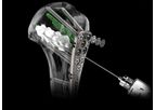 Biedermann - Model MDS - Injection Screw