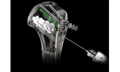 Biedermann - Model MDS - Injection Screw