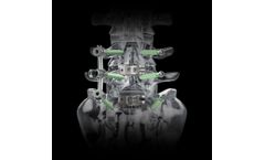 Biedermann - Model MOSS 100 - Pedicle Screw System