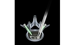 TELIX - Model K - Steerable Interbody System