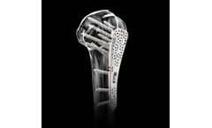 Biedermann - Proximal Humerus  Plating System
