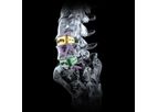 Cobra - Anterior Lumbar Interbody Fusion Device with Integrated Fixation