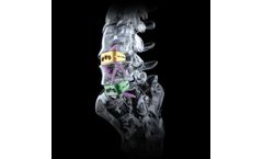 Cobra - Anterior Lumbar Interbody Fusion Device with Integrated Fixation