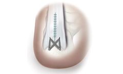 OSSIO - Stand-Alone Sutures