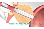 Allium Medical TPS stent 2019 - Video