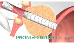 Allium Medical TPS stent 2019 - Video