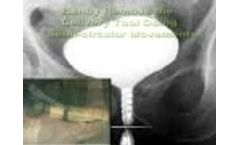 Demo of the Round Posterior Urethral Stent (RPS) - Video