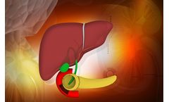 Allium - Biliary Stricture