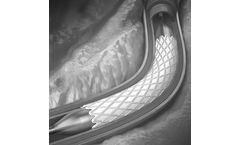 Aran - PTFE Covered Stents