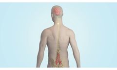 Mainstay Medical`s ReActiv8 Therapy for Chronic Mechanical Low Back Pain. - Video