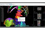 OOOPDS - Surgical Planning for a Spinal Puncture (Vertebroplasty) - Video