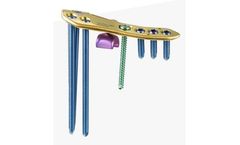 CORENTEC - Model LCfit - High Tibial Osteotomy (HTO) Plate System