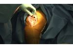 TKR Lospa Knee System - Video