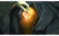 TKR Lospa Knee System - Video