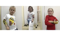 Upper Limbs Prosthetics Service