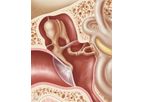 Middle Ear Implants