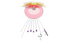 Model Disc-FX – Lumbar - Safely, Rapidly and Effectively Treat Discogenic Pathologies