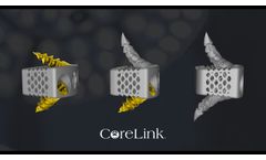 CoreLink F3D-C2 Stand-alone Cervical System with Fusation Anchors - Video