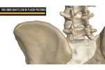 CoreLink SIber Posterior SI Allograft System - Video