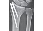 T-Pin - Fixation System for Distal Radius & Distal Ulna Fracture Fixation