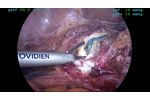 Low pressure colpotomy using Ultravision - Video