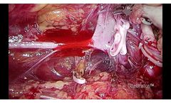 Laparoscopic Retroperitoneal Nephrectomy Using Ultravision - Video