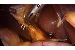 Laparoscopic Cholecystectomy using Ultravision - Video