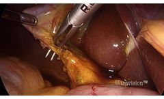 Laparoscopic Cholecystectomy using Ultravision - Video