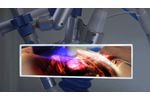 Cardiospec - Extracorporeal Shockwave Myocardial Revascularization (ESMR) - Video