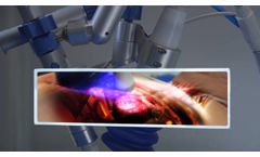 Cardiospec - Extracorporeal Shockwave Myocardial Revascularization (ESMR) - Video
