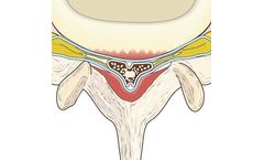 mild - Back and Leg Pain Solution